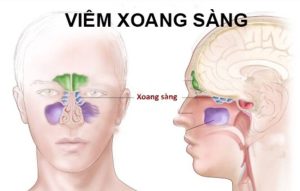 Bệnh viêm xoang sàng đang dần phổ biến