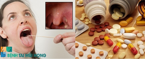 Khám và dùng thuốc điều trị viêm họng theo chỉ định của bác sĩ
