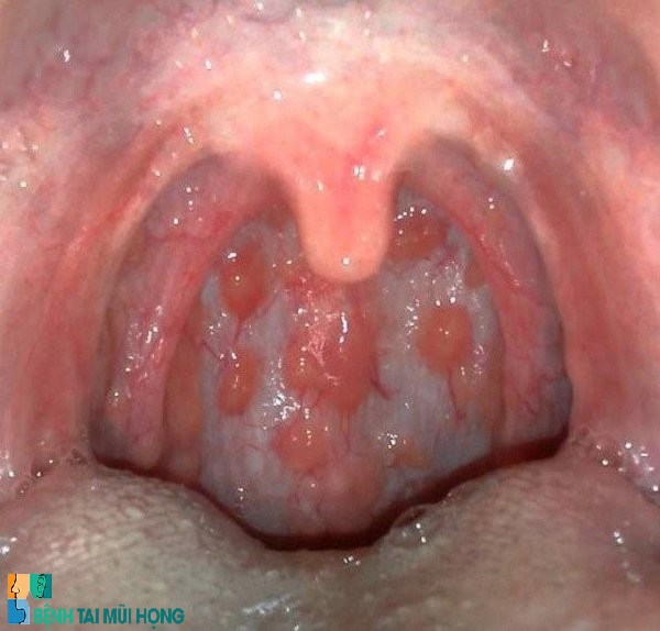 Viêm họng hạt là một dạng bệnh lý rất phổ biến của viêm họng