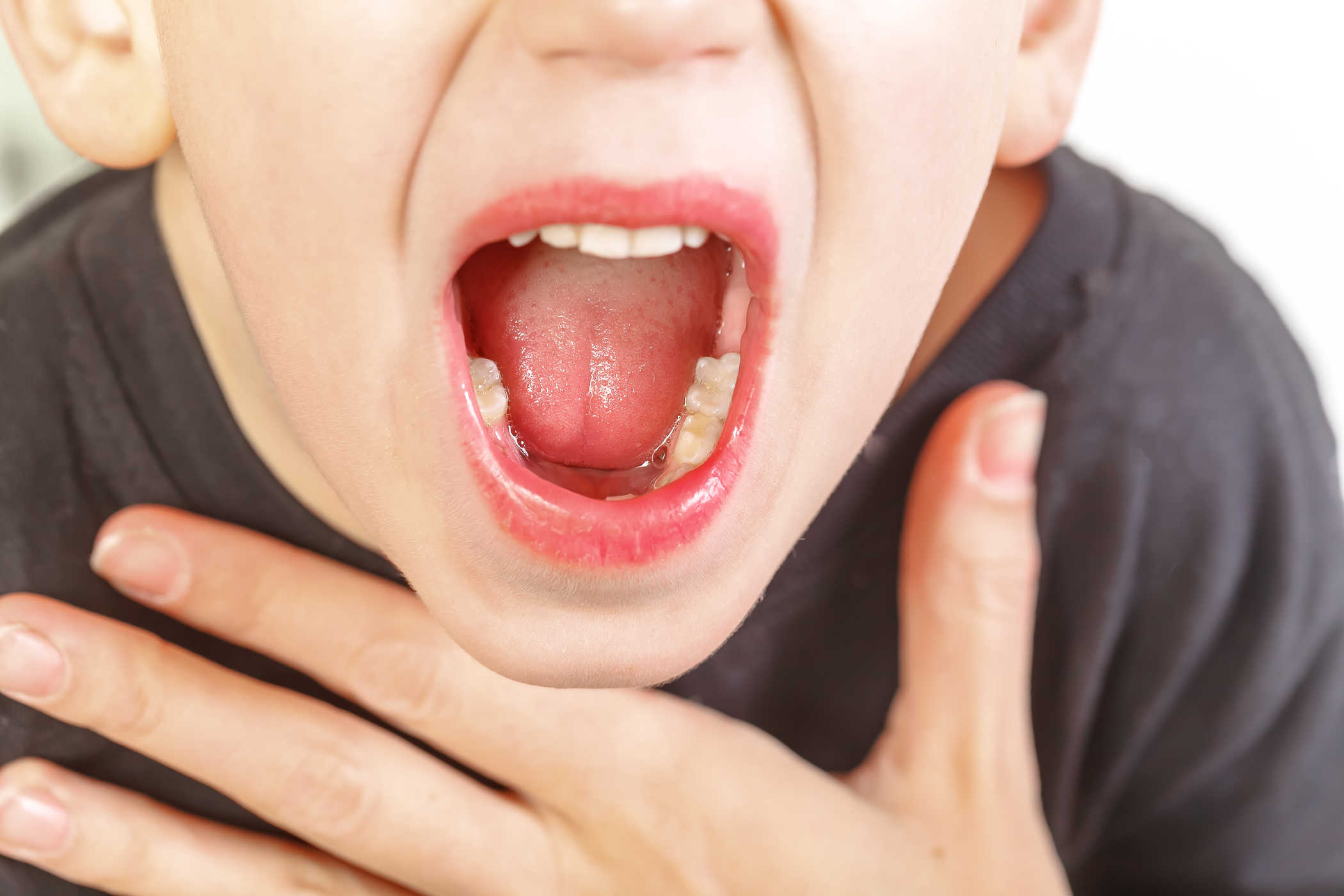 Viêm họng hạt gây nhiều phiền toái cho sức khỏe