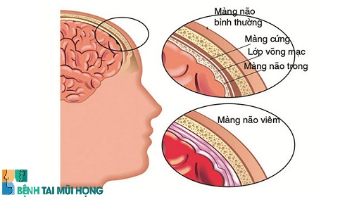 Viêm tai giữa có thể gây biến chứng nguy hiểm như viêm màng não