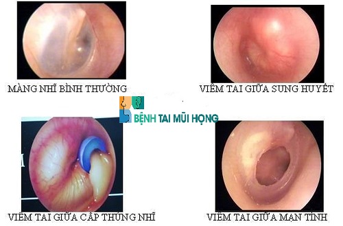 Hình ảnh của viêm tai giữa xung huyết