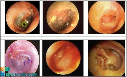 Các hình ảnh của bệnh viêm tai ngoài