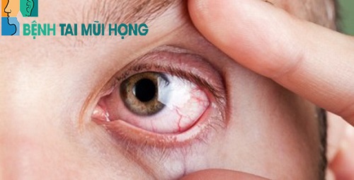 Mắt đỏ - Dấu hiệu nhận biết viêm mũi dị ứng ngứa mắt