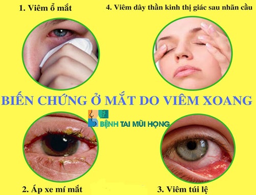 Một số biến chứng viêm xoang nguy hiểm ở mắt