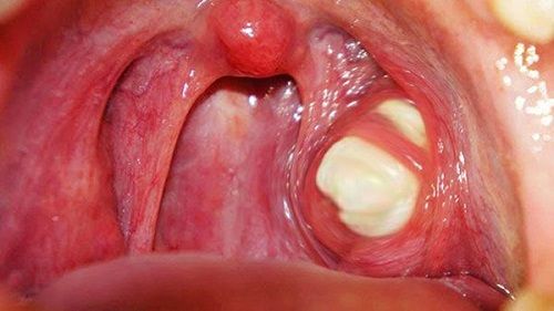 Viêm tấy quanh vòm họng là biến chứng nguy hiểm của bệnh viêm họng hạt mãn tính