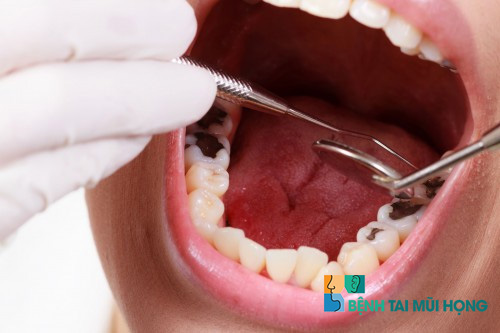 Chữa răng hàm trước khi thực hiện chữa viêm xoang hàm đối với trường hợp viêm do răng