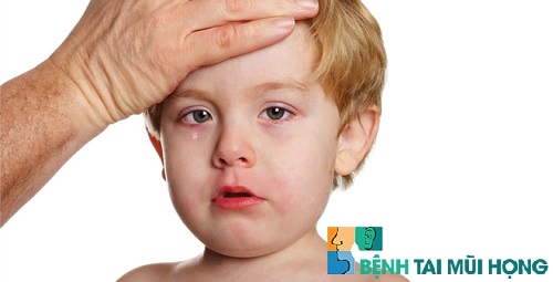 Dấu hiệu viêm xoang ở trẻ em: Sốt cao, ho và quấy khóc