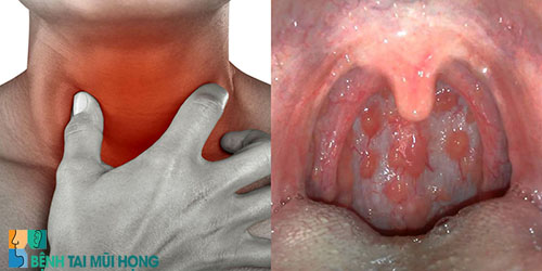 Viêm họng hạt là bệnh gì?