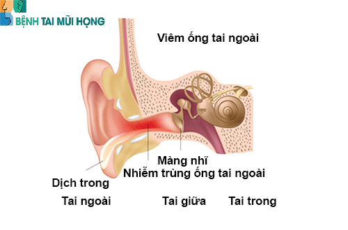 Đau tai phải có thể là triệu chứng của viêm tai ngoài