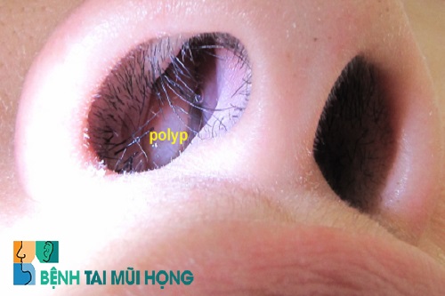 Poplyp mũi là một trong những nguyên nhân gây bệnh thường gặp