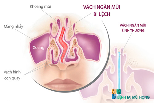 Trường hợp vách ngăn sống mũi bị lệch gây viêm xoang mãn tính
