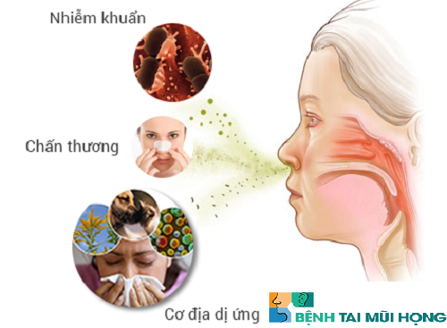 Những nguyên nhân viêm xoang mũi thường gặp