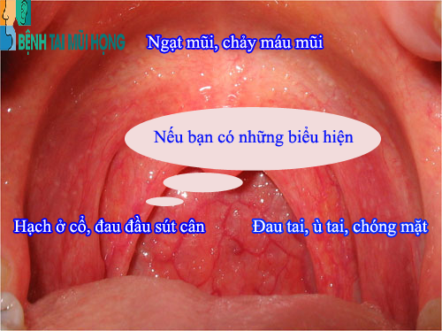 Những dấu hiệu nhận biết viêm vòm họng giai đoạn đầu.
