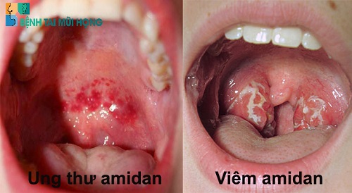 Phân biệt viêm amidan và ung thư amidan thông qua hình ảnh