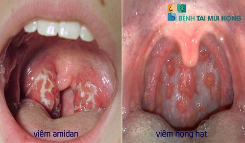 Sự khác biệt của viêm amidan và viêm họng hạt qua hình ảnh