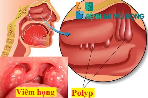 Xoang hàm xuất hiện polyp khiến dịch nhầy chảy xuống cổ họng gây ra nhiều bệnh khácXoang hàm xuất hiện polyp khiến dịch nhầy chảy xuống cổ họng gây ra nhiều bệnh khác