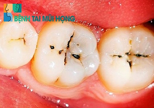 Các bệnh về răng có thể gây bệnh xoang hàm phải