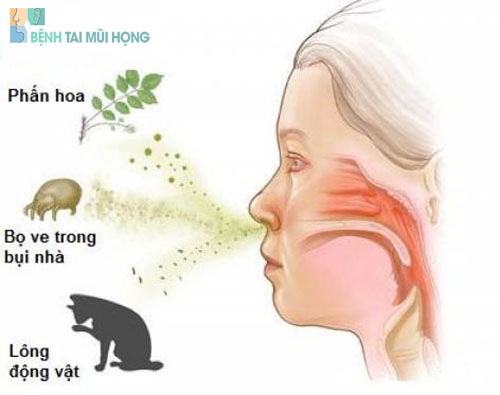 Nguyên nhân gây viêm mũi dị ứng thường gặp
