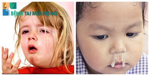 Sổ mũi, sốt, ho là những triệu chứng phổ biến của bệnh viêm xoang ở trẻ