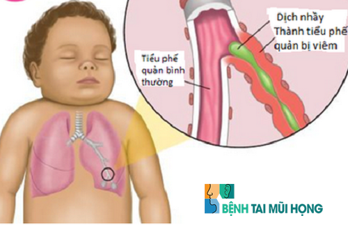 Trẻ dưới 2 - 3 tuổi thường bị ngạt mũi khó thở do cuống phổi chưa phát triển hết