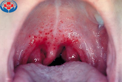 hình ảnh bệnh viêm họng hạt