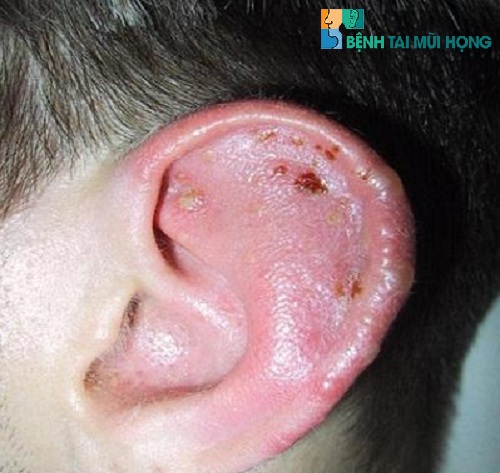 Triệu chứng của bệnh viêm lỗ tai ngoài