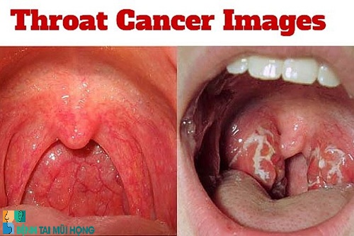 Có nhiều nguyên nhân gây ung thư vòm họng