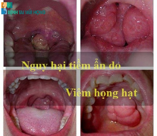 Viêm họng hạt sẽ khó điều trị hơn viêm họng cấp rất nhiều