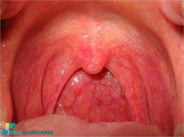 Viêm họng cấp tính là tình trạng bệnh viêm nhiễm cấp tính ở niêm mạc họng