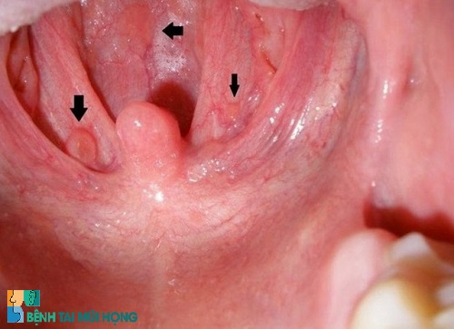 Ung thư vòm họng là biến chứng nguy hiểm nhất của viêm họng đỏ
