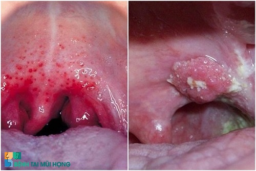 Phân biệt viêm họng hạt cấp tính và ung thư vòm họng