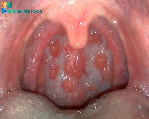 Viêm họng hạt cấp do nhiều nguyên nhân thông thường gây ra