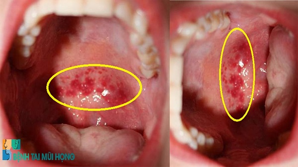 Viêm họng hạt là tình trạng bệnh lý viêm nhiễm mãn tính ở họng