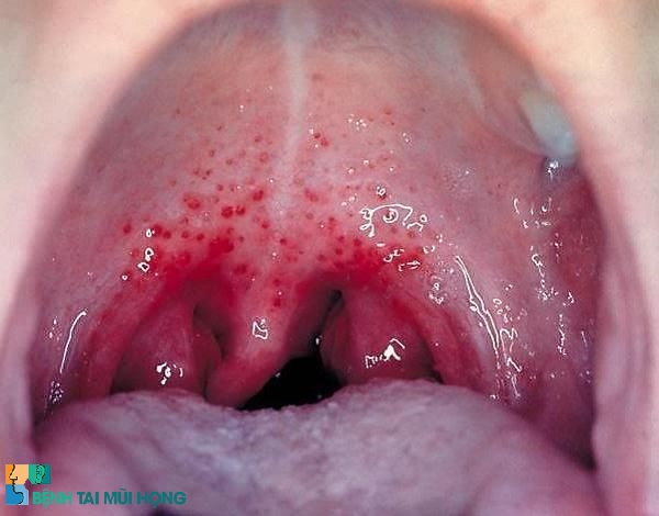 Triệu chứng của bệnh là tình trạng niêm mạc họng sưng đỏ