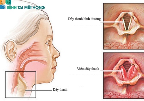 Viêm họng viêm thanh quản là bệnh gì?