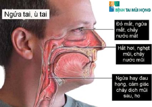Triệu chứng bệnh viêm mũi