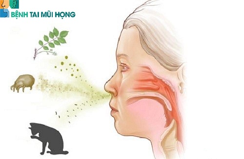 Viêm mũi dị ứng có thể tìm ra căn nguyên gây bệnh, còn viêm mũi vận mạch thì không