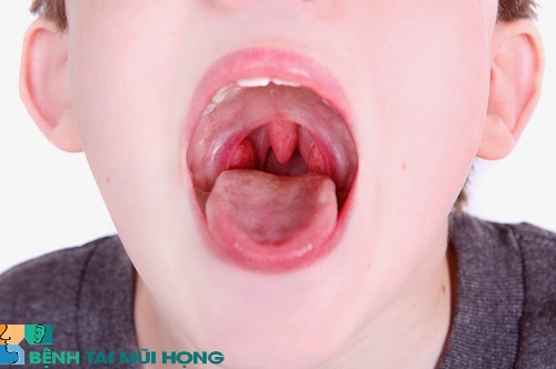 Viêm mũi xoang xuất tiết có thể biến chứng thành: Viêm họng mãn tính, viêm phế quản mãn tính,….