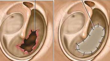viêm tai giữa cấp thủng màng nhĩ