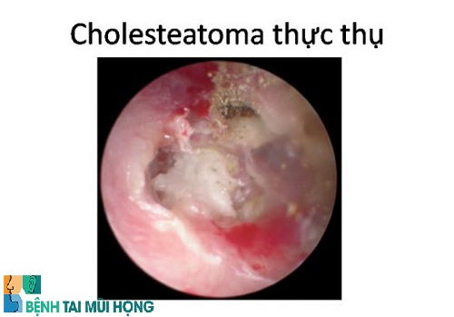 Viêm tai giữa chảy mũ mãn tính có Cholesteatoma