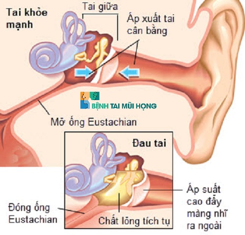 Viêm tai giữa thanh dịch là bệnh gì?