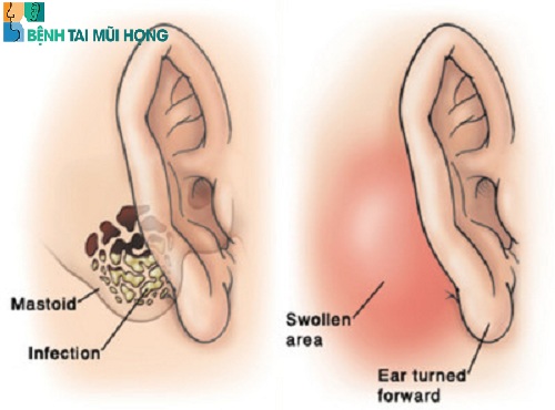 Hình ảnh bệnh viêm tai xương chũm