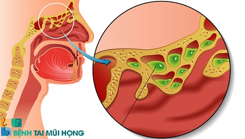  Viêm xoang mãn tính dịch nhầy thường chảy xuống cổ họng gây các bệnh về đường hô hấp