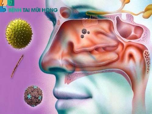 vi khuẩn, nấm, virus lúc nào cũng có thể tấn công gây viêm xoang mũi thể cấp