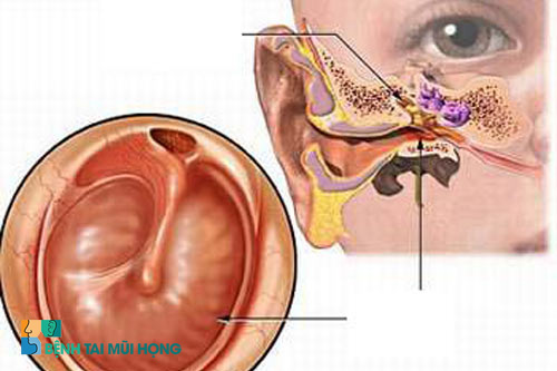 Viêm xoang mũi gây mủ ở tai