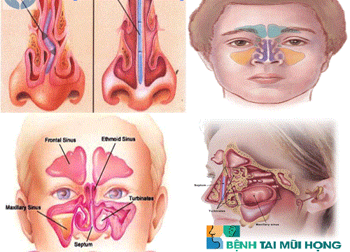 Lệch vách ngăn mũi – Nguyên nhân gây viêm xoang nặng
