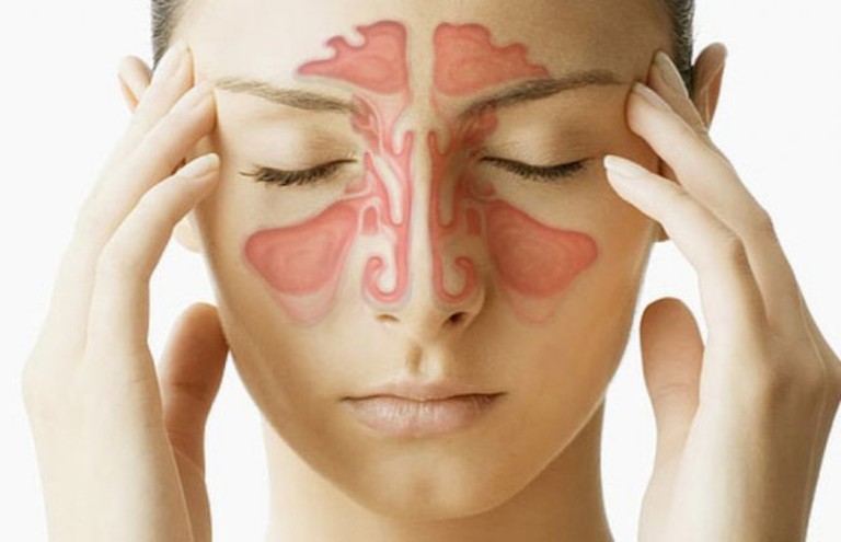 Viêm xoang hàm gây ra nhiều triệu chứng khó chịu